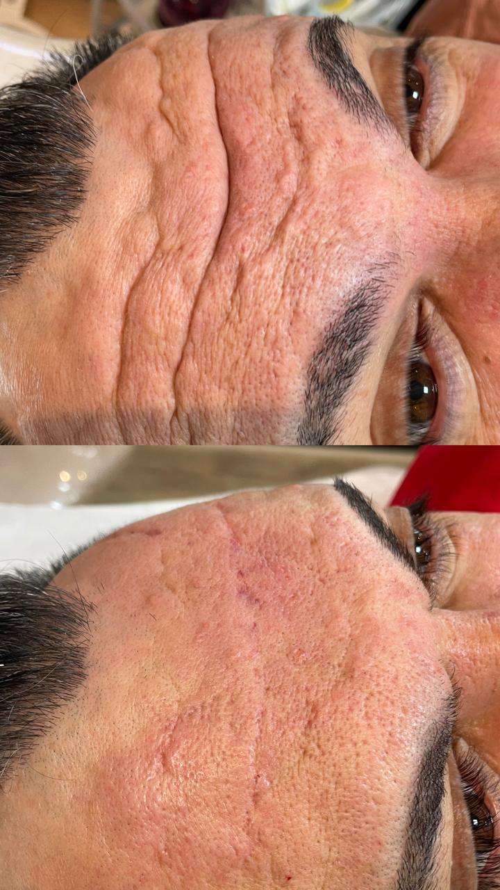 Botox Masculino