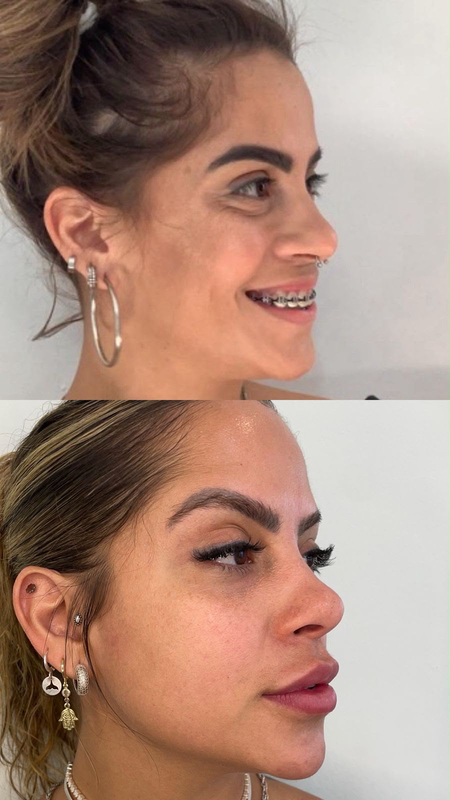 Harmonização Facial