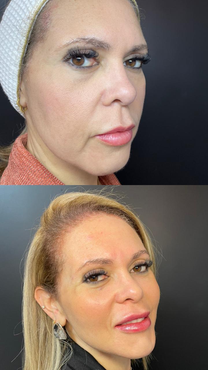 Harmonização Facial