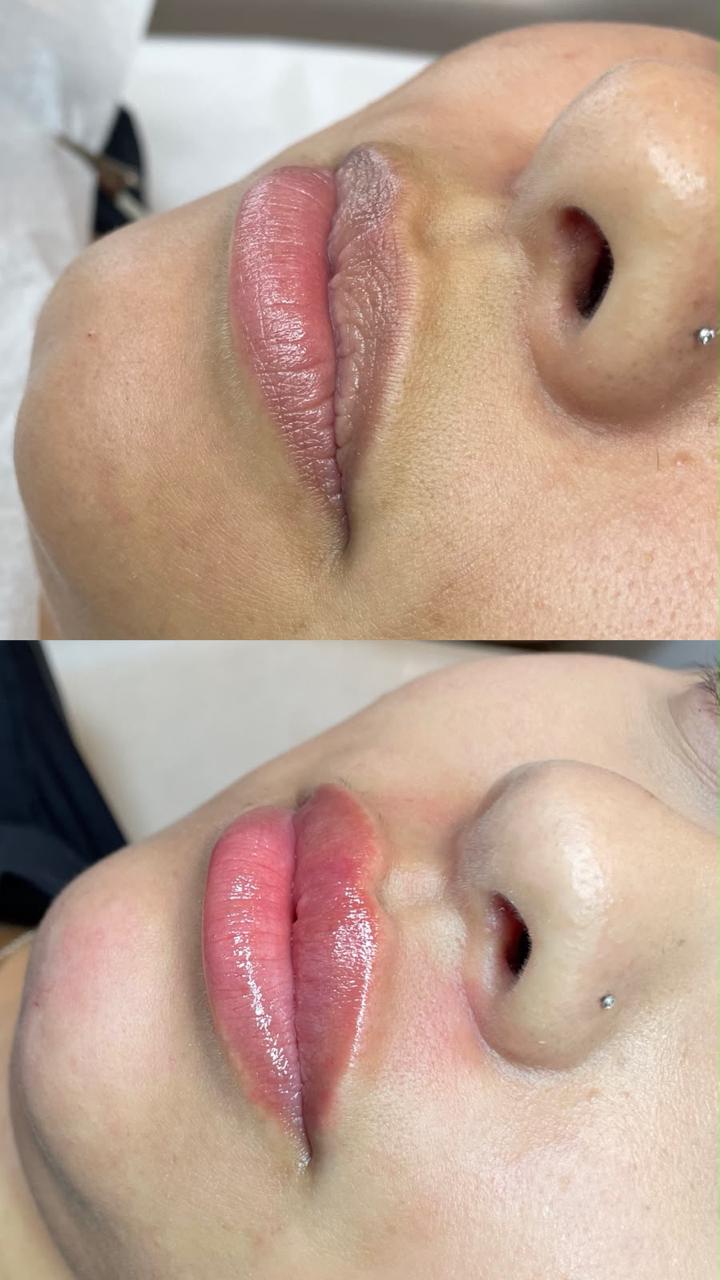 Preenchimento Labial