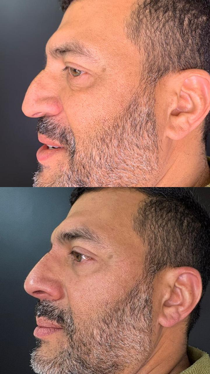 Rinomodelação Masculina
