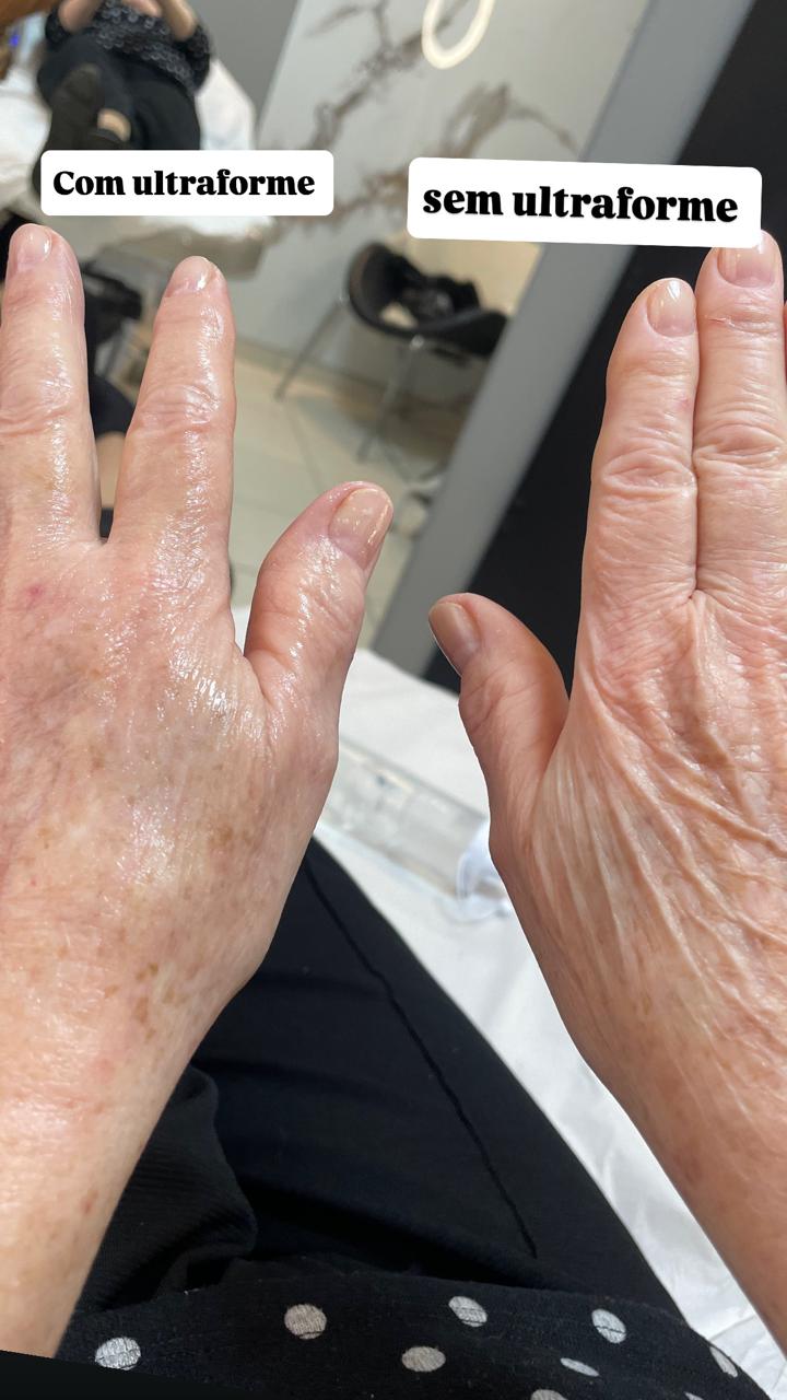 Ultraforme